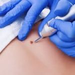 Mole Removal Risks and Complications
